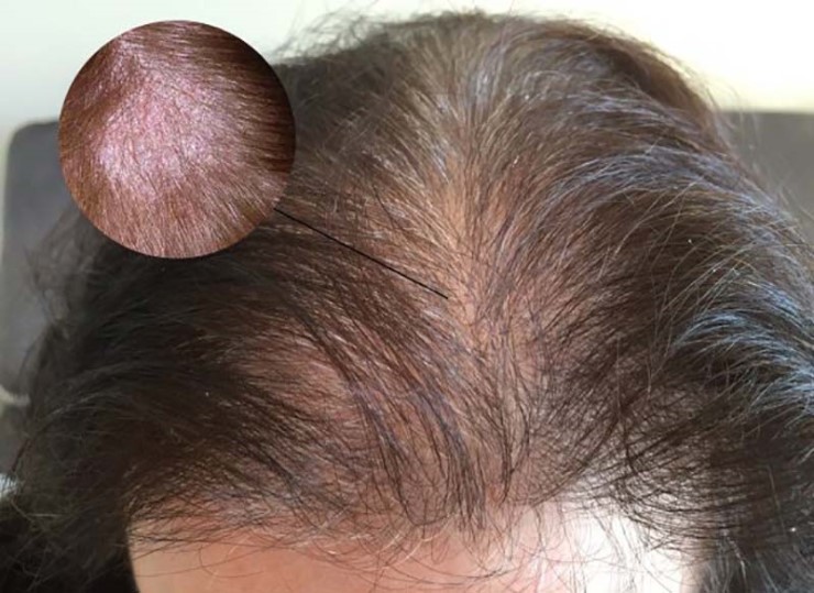 Viêm da đầu nguyên nhân dẫn đến hiện tượng rụng tóc.