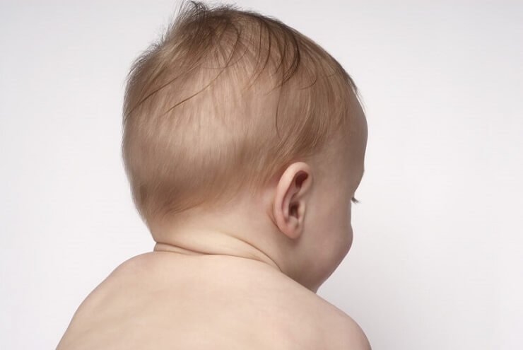 Rụng tóc vành khăn ở trẻ 2 tháng tuổi
