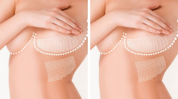 Ngực nhỏ và cách khắc phục bằng cách massage ngực